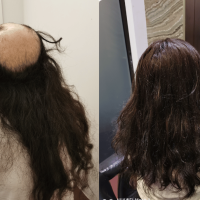 Hair transplant singapore cost