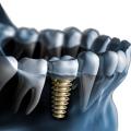 Dental implants