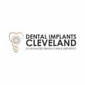Dental Implants Cleveland