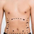 tummytuck