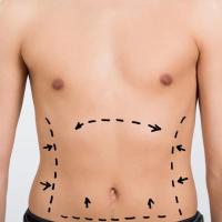 tummytuck